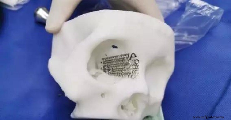 Titanium Alloys Revolutionize Orbital Fracture Repair