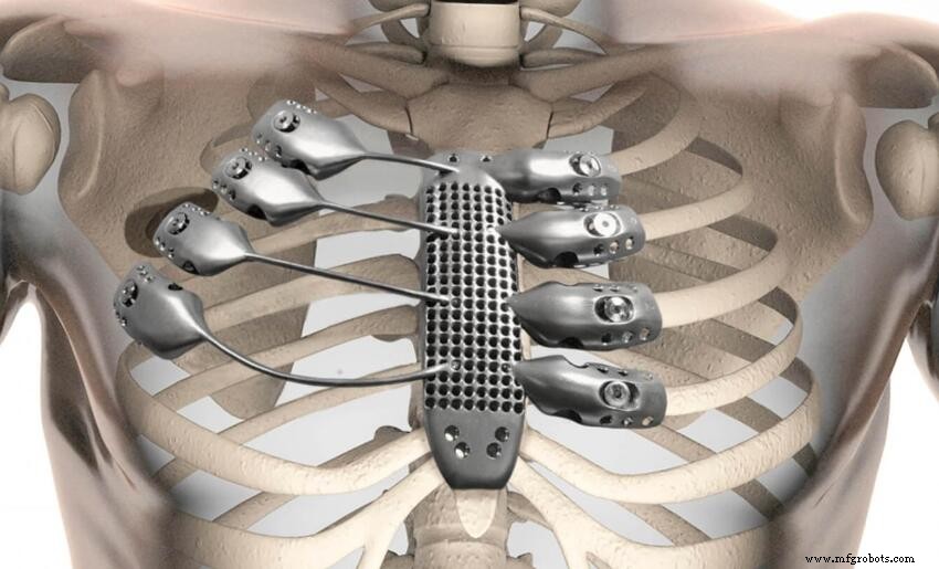 Titanium Alloy 3D Printing: Applications, Benefits, and Industry Use Cases