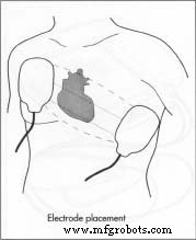External Defibrillator: History, Design, and Manufacturing
