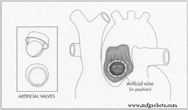 Artificial Heart Valves: Types, History, and Future Innovations