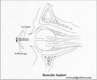 Artificial Eye Prostheses: From History to Cutting‑Edge Innovation