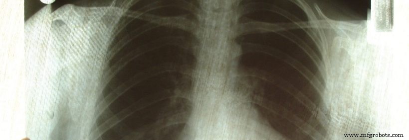 Shanghai Surgeons Print Custom Titanium Bone Implants for Cancer Patient