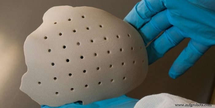 Revolutionizing Bone Implants: How 3D Printing Enhances Fit, Longevity, and Performance
