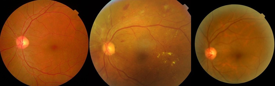 Build an Offline AI Model that Detects Diabetic Retinopathy Stages with Edge‑Impulse