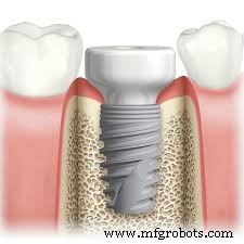 PEEK Medical Implants: Advanced Biocompatible Solutions for Spinal, Orthopedic, Cardiovascular, and Dental Applications