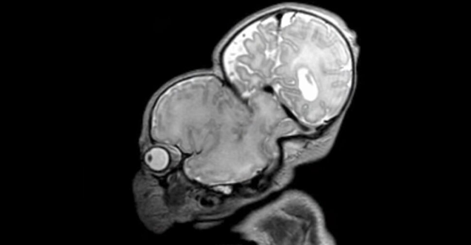 3D‑Printed Surgical Models Enable Historic Separation of Rare Head‑Fused Twins