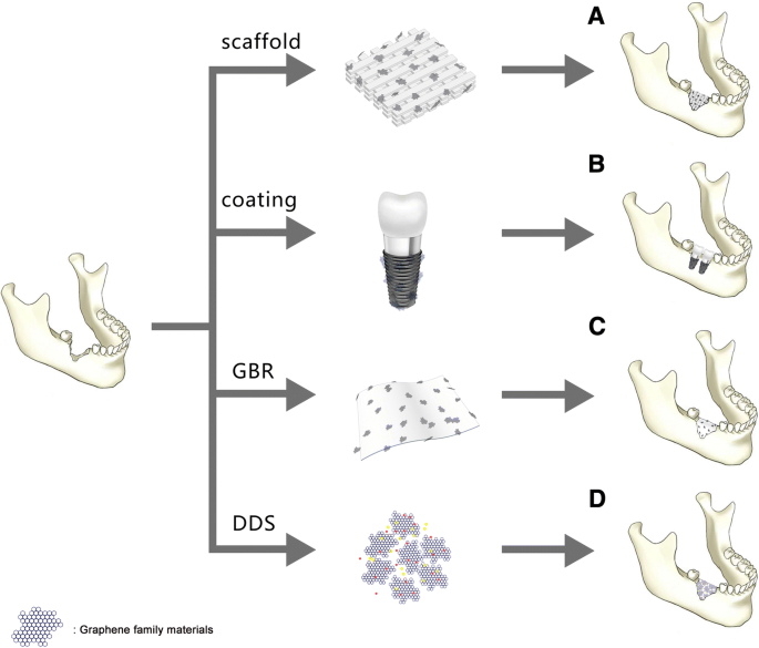 Graphene‑Based Materials for Bone Regeneration: Opportunities, Challenges, and Clinical Perspectives