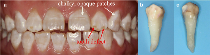 Gradient Nanomechanical Properties of Fluorosed Enamel: Implications for Restorative Material Selection