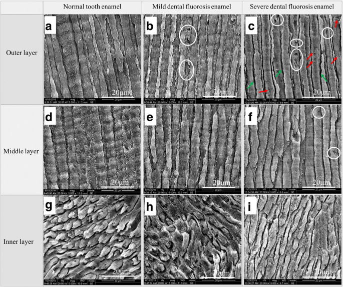 Gradient Nanomechanical Properties of Fluorosed Enamel: Implications for Restorative Material Selection