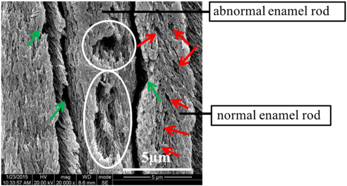 Gradient Nanomechanical Properties of Fluorosed Enamel: Implications for Restorative Material Selection