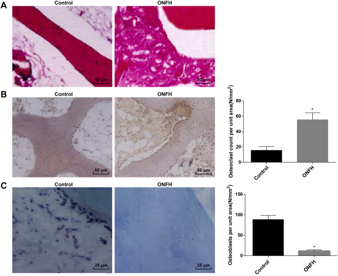 Targeting miR‑410/Wnt‑11 Regulates Bone Formation and Inhibits Osteoclasts to Treat Femoral Head Osteonecrosis
