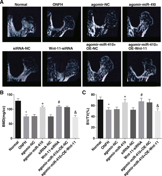 Targeting miR‑410/Wnt‑11 Regulates Bone Formation and Inhibits Osteoclasts to Treat Femoral Head Osteonecrosis