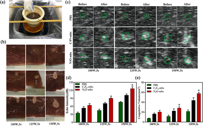 Improving HIFU Cancer Therapy Using Sonodynamic N2O Microbubbles