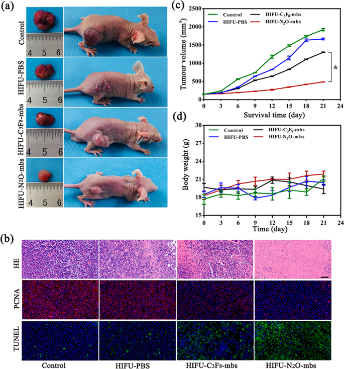 Improving HIFU Cancer Therapy Using Sonodynamic N2O Microbubbles