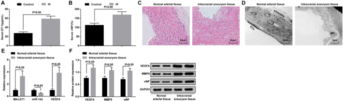 MALAT1/miR-143/VEGFA Axis Drives Endothelial Damage Leading to Intracranial Aneurysm