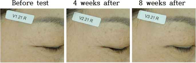 Polymeric Micelle Delivery of Oleanolic Acid: Enhanced Solubility and Proven Anti‑Wrinkle Efficacy