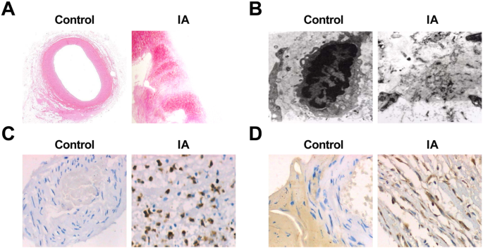 Restoring miR‑133a‑3p or Reducing PSAT1 Limits Endothelial Damage‑Driven Intracranial Aneurysm by Inhibiting the GSK3β/β‑Catenin Pathway