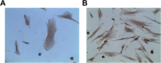 Restoring miR‑133a‑3p or Reducing PSAT1 Limits Endothelial Damage‑Driven Intracranial Aneurysm by Inhibiting the GSK3β/β‑Catenin Pathway
