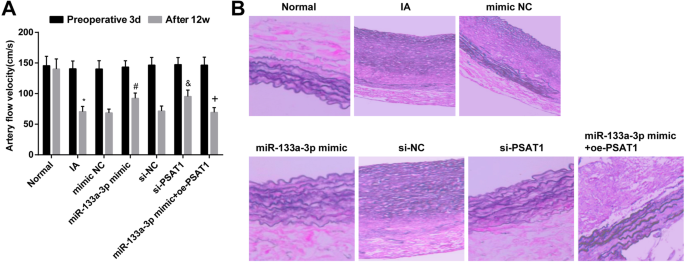 Restoring miR‑133a‑3p or Reducing PSAT1 Limits Endothelial Damage‑Driven Intracranial Aneurysm by Inhibiting the GSK3β/β‑Catenin Pathway