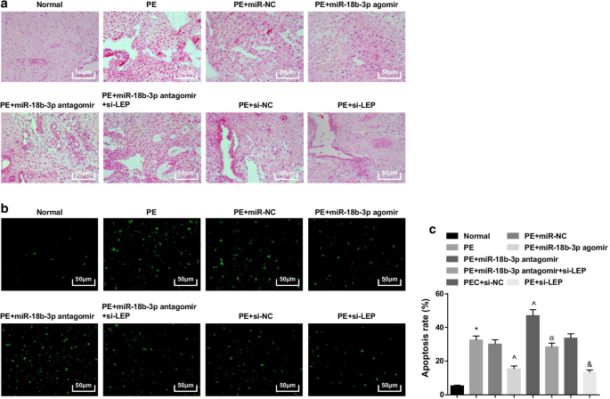 Exosomal miR‑18b‑3p from Human Umbilical Cord MSCs Lowers Preeclampsia Risk by Targeting Leptin