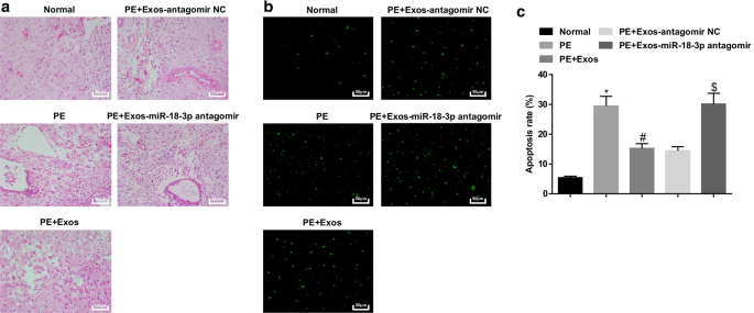 Exosomal miR‑18b‑3p from Human Umbilical Cord MSCs Lowers Preeclampsia Risk by Targeting Leptin