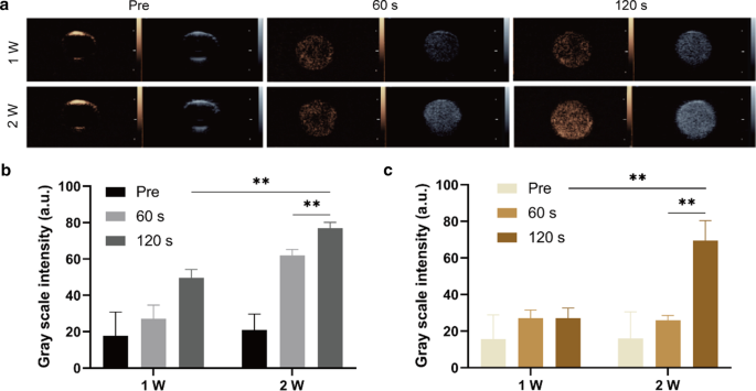 Ultrasound-Enhanced Multifunctional Nanoparticles: A Novel Platform for Imaging and Synergistic Therapy of Metastatic Breast Cancer