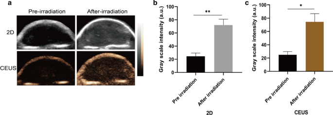 Ultrasound-Enhanced Multifunctional Nanoparticles: A Novel Platform for Imaging and Synergistic Therapy of Metastatic Breast Cancer