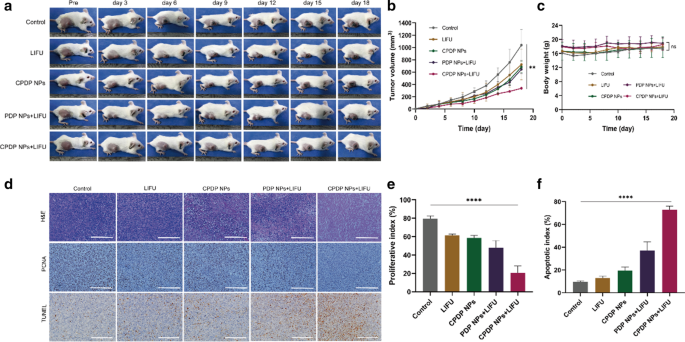 Ultrasound-Enhanced Multifunctional Nanoparticles: A Novel Platform for Imaging and Synergistic Therapy of Metastatic Breast Cancer