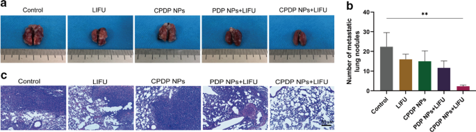 Ultrasound-Enhanced Multifunctional Nanoparticles: A Novel Platform for Imaging and Synergistic Therapy of Metastatic Breast Cancer