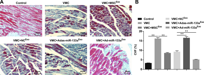 Exosomal miR-133a from Bone Marrow Stem Cells Mitigates Fibrosis & EMT in Viral Myocarditis via MAML1 Suppression