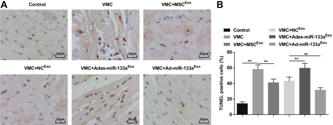 Exosomal miR-133a from Bone Marrow Stem Cells Mitigates Fibrosis & EMT in Viral Myocarditis via MAML1 Suppression