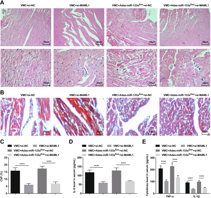 Exosomal miR-133a from Bone Marrow Stem Cells Mitigates Fibrosis & EMT in Viral Myocarditis via MAML1 Suppression