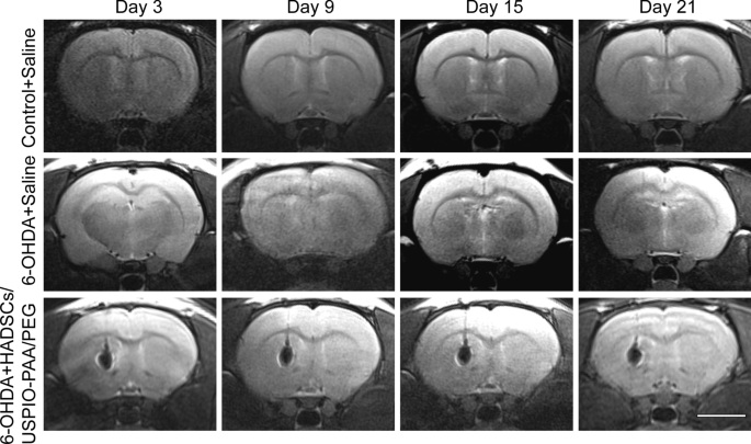 Ultrasmall Superparamagnetic Iron Oxide Nanoparticles for Stem Cell Tracking in Parkinson’s Therapy