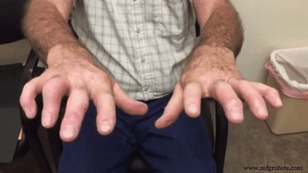 Intelligent Spoon Aid for Parkinson’s Patients