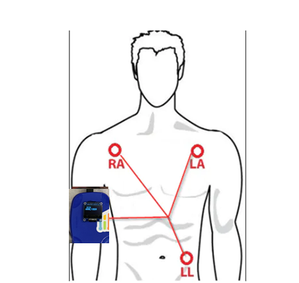 Precision ECG Analyzer with Edge Impulse and Arduino Nano 33 BLE Sense