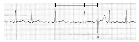 Precision ECG Analyzer with Edge Impulse and Arduino Nano 33 BLE Sense