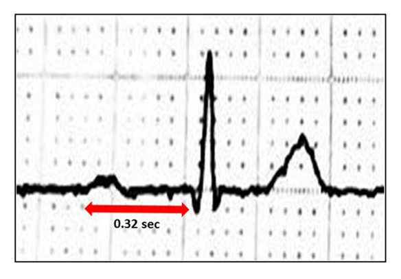 Precision ECG Analyzer with Edge Impulse and Arduino Nano 33 BLE Sense