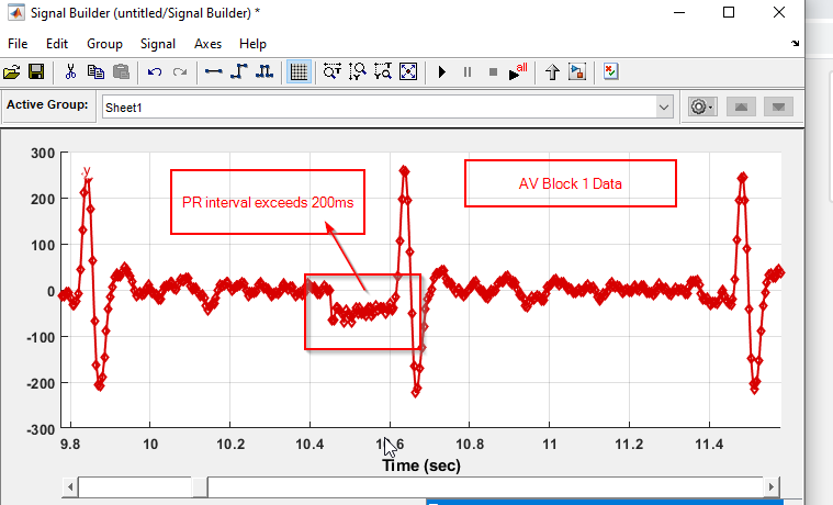 Precision ECG Analyzer with Edge Impulse and Arduino Nano 33 BLE Sense