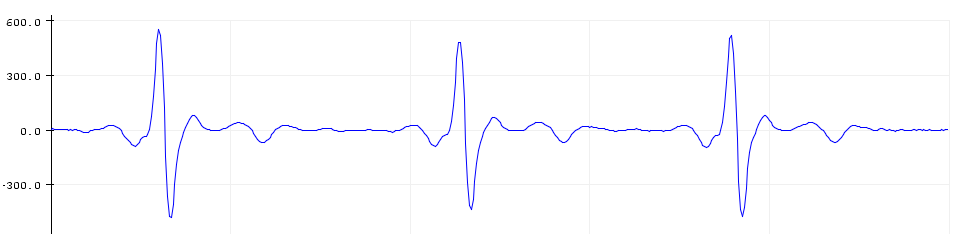 Precision ECG Analyzer with Edge Impulse and Arduino Nano 33 BLE Sense