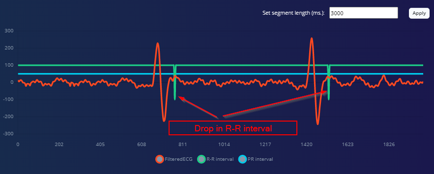 Precision ECG Analyzer with Edge Impulse and Arduino Nano 33 BLE Sense