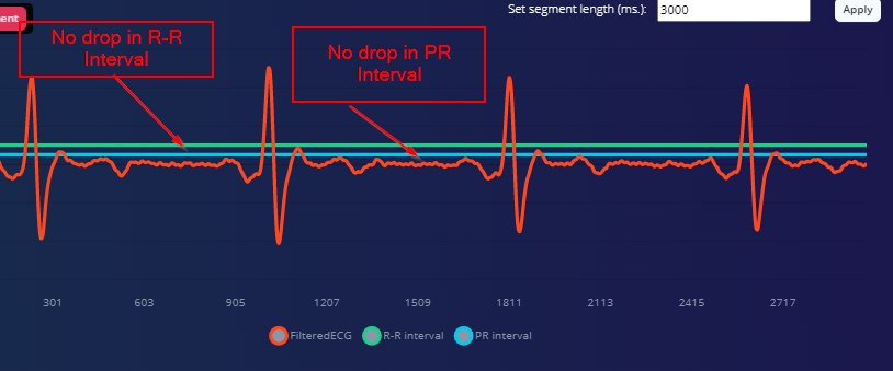 Precision ECG Analyzer with Edge Impulse and Arduino Nano 33 BLE Sense