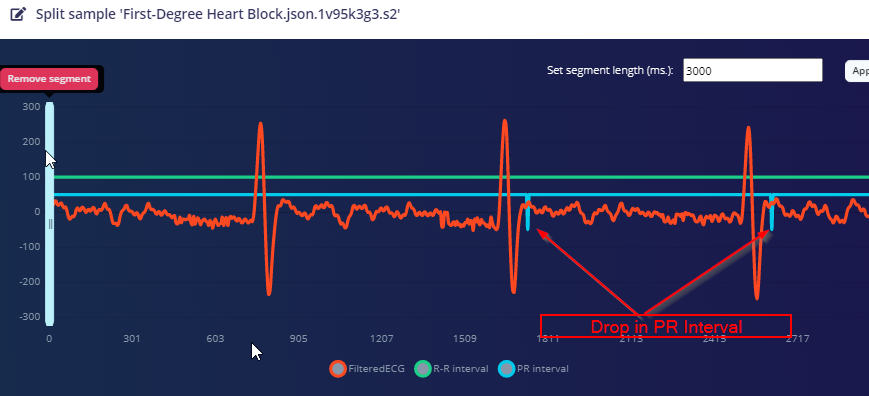 Precision ECG Analyzer with Edge Impulse and Arduino Nano 33 BLE Sense