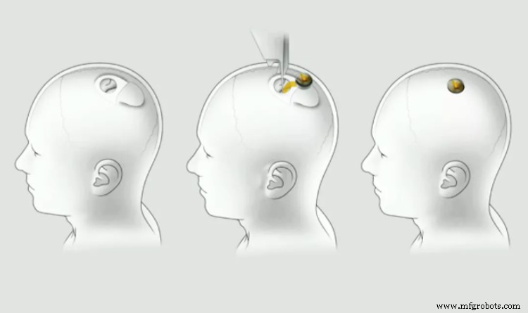 Elon Musk’s Neuralink: Brain‑Chip Tech and Its Impact on Humanity