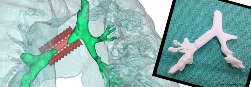 How 3D Modeling Transforms Airway Splints and Stents: Enhancing Precision and Patient Outcomes